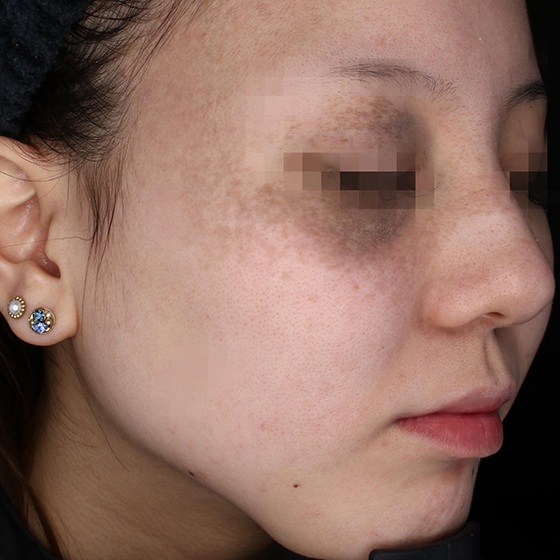 Picosure pro before picture