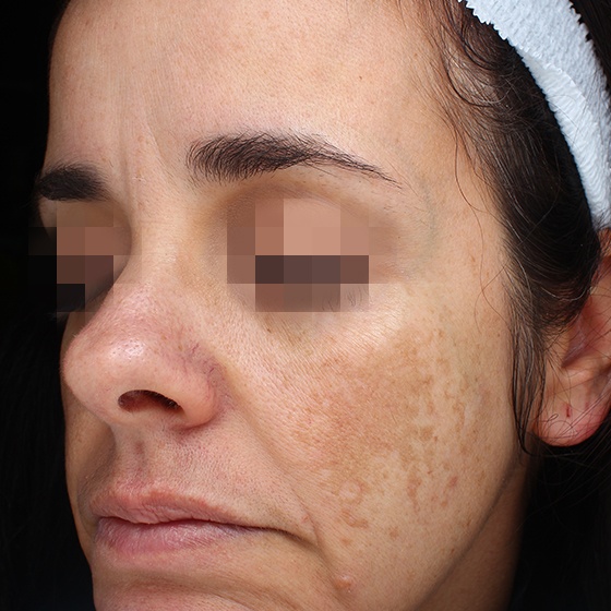 Picosure pro before picture