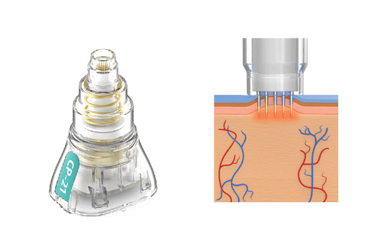 potenza-fusion-tip-2