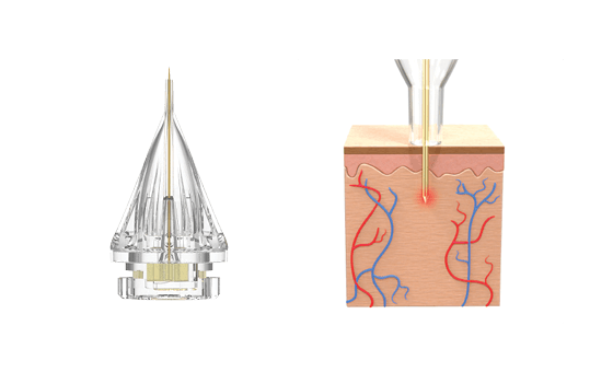 potenza-single-needle-2